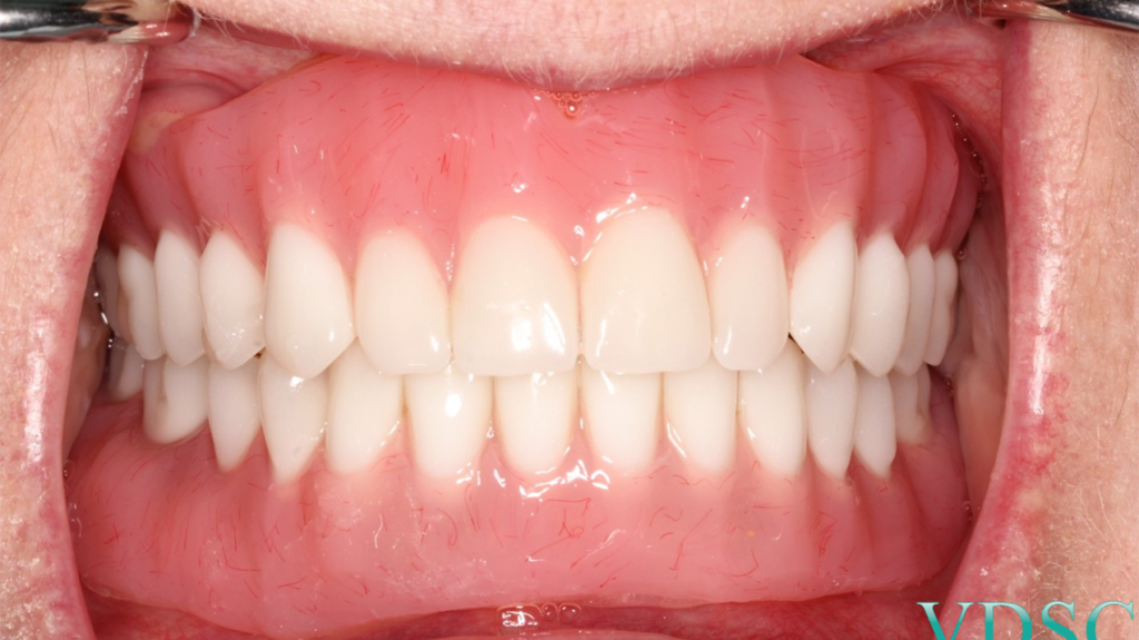 Process for Getting Immediate Dentures